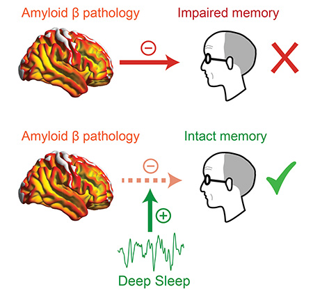 diagram showing two brains with beta-amyloid pathology and an arrow pointing to a cartoon man's head. The top image, with less deep sleep, corresponds with less memory retention. The bottom image, with more deep sleep, corresponds with intact memory — suggesting deep sleep may ward off some of the effects of dementia.