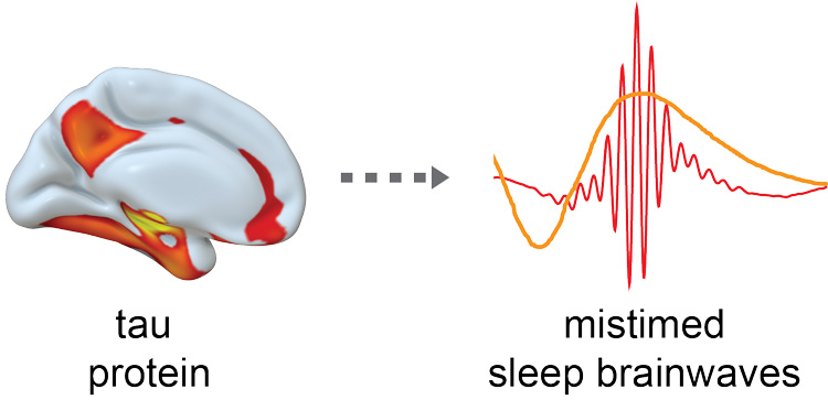 tau protein in brain makes brainwaves out of sync