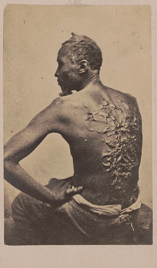 An 1863 photograph of an escaped slave show the scars left by a brutal whipping 