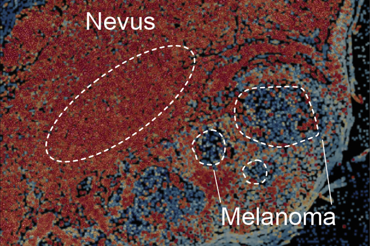 nevus that is transitioning into a melanoma