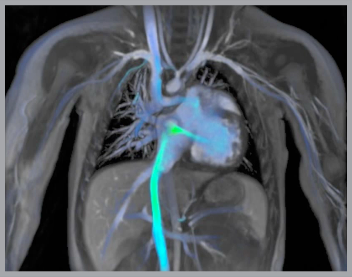 image shows cardiac flow of a 3 year old patient 