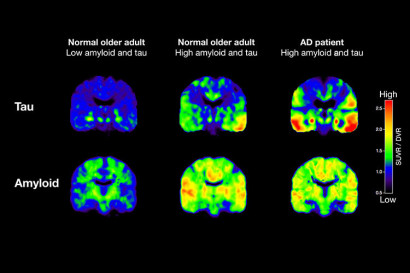 PET scans that track tau (top row) and beta-amyloid from two normal older people and one patient with Alzheimer’s disease (AD).