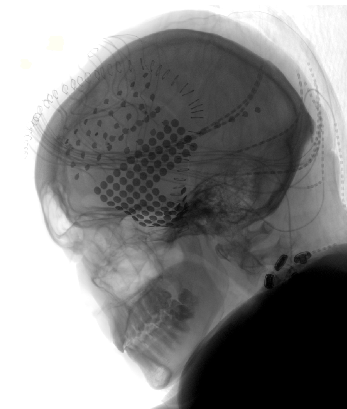 B&W X-ray of skull, showing electrodes on brain