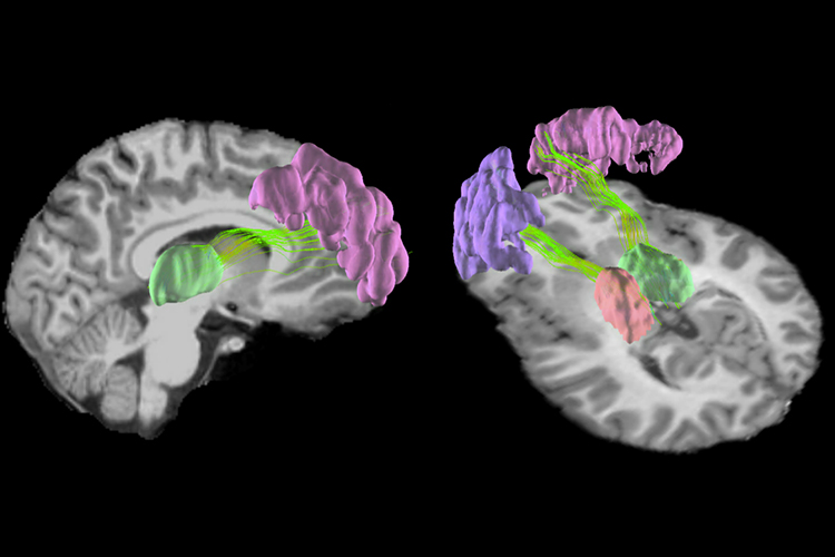 A 3D representation of a magnetic resonance imaging scan, showing areas in the front and rear of the brain lit up.