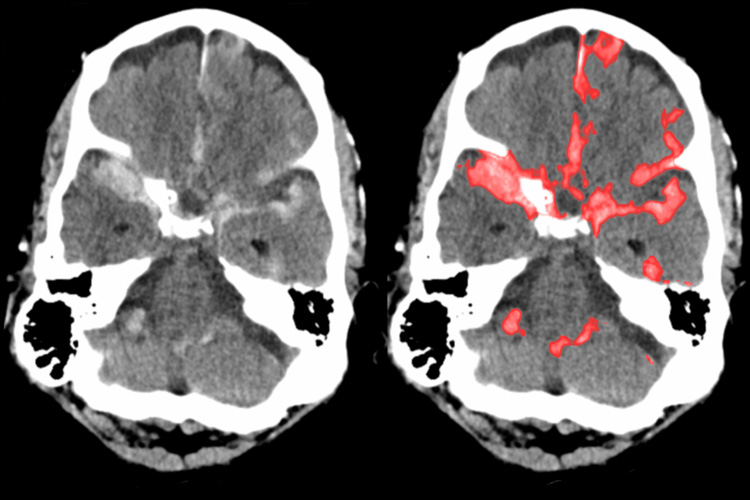 brain scan showing hemorrhage