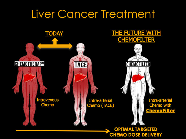 human body showing improvements in liver cancer treatment