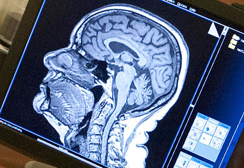 MRI of the brain