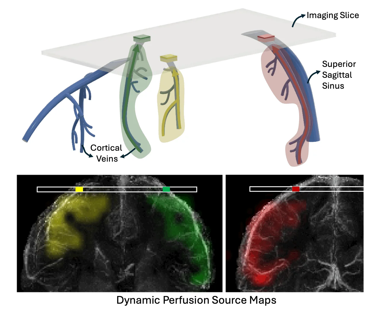 Top: Schematic showing how different veins drain distinct regions of the brain, known as their territories. Bottom: Animated visualization demonstrating how DiSpect traces the origin of blood arriving to different cortical veins in the brain, resolving their territories.