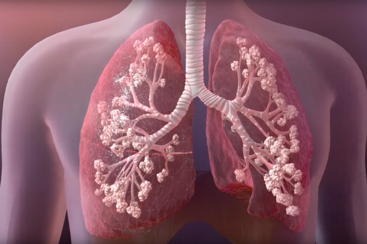 Discovery could help improve cystic fibrosis treatment | Research UC  Berkeley