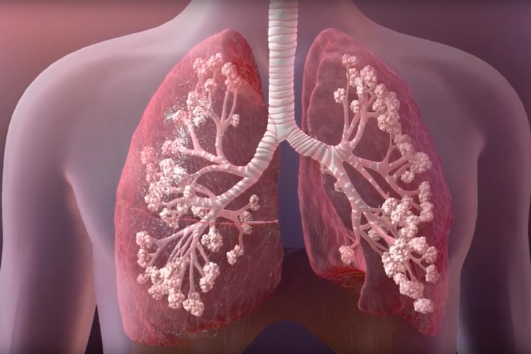 image of human lungs