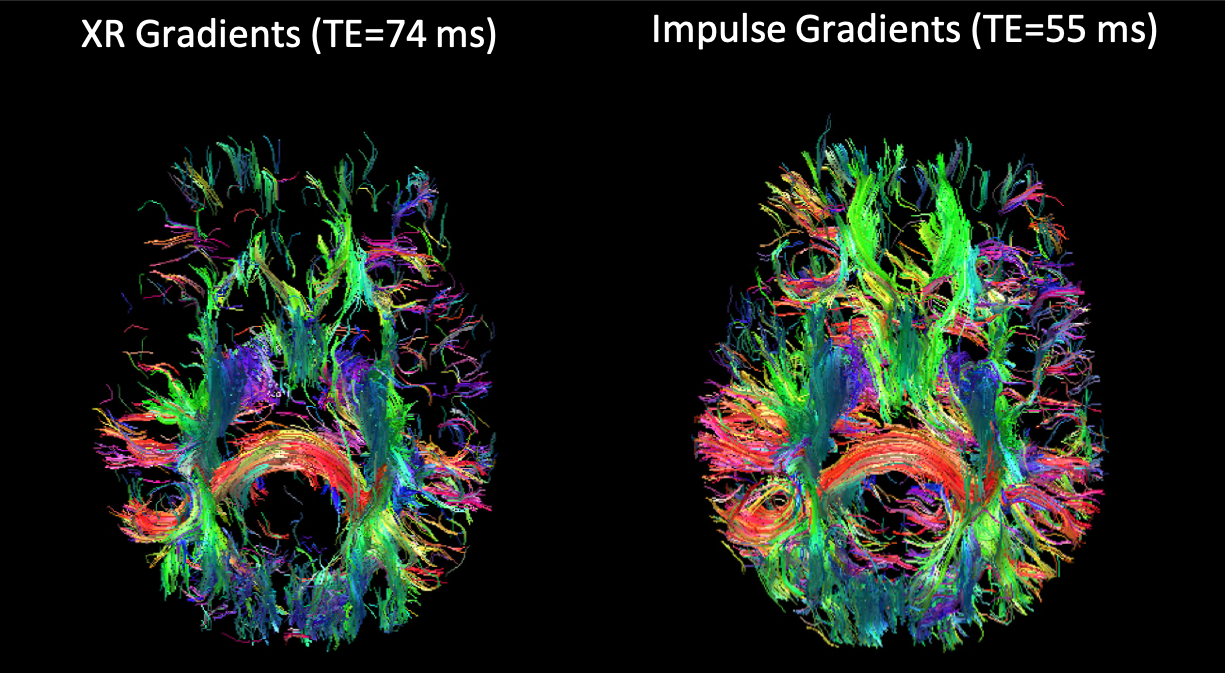 side-by-side colorful clusters of axons in the brain