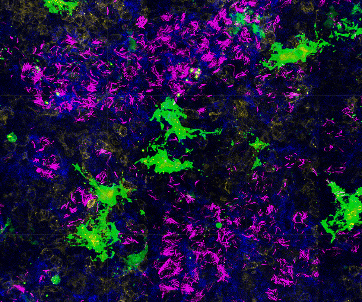 An image of Mycobacterium tuberculosis (in magenta) in a lung 25 days after infection (Image credit: Ophelia V. Lee)