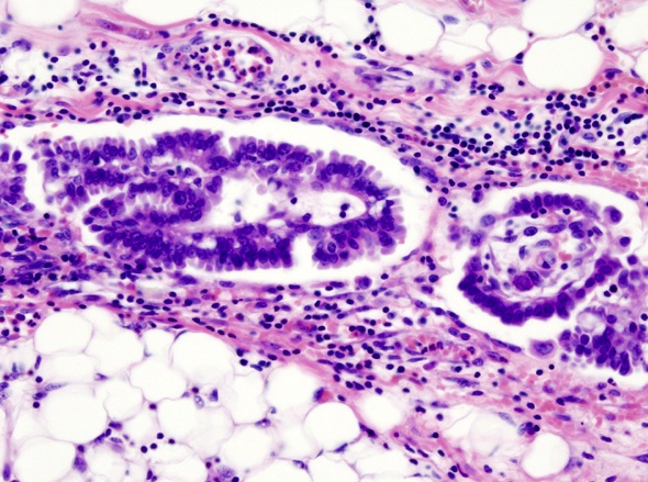 microscopic image of Adenocarcinoma.