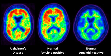 Scans of three different brains: one with alzheimers, one that is Amyloid positive, and one that is negative.