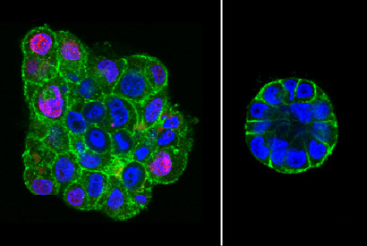 Florescent images of malignant breast epithelial cells