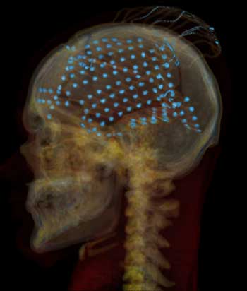 An X-ray of a human skull with blue electrode dots.