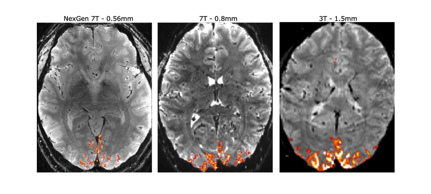 3 gray and white slices through the brain with a few areas highlighted in orange and yellow