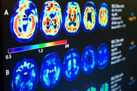 Photo of brain scans