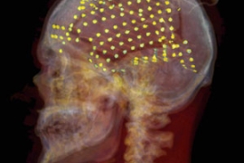 Skull x-ray with yellow dots indicating speech regions
