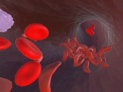 painting of sickled red blood cells