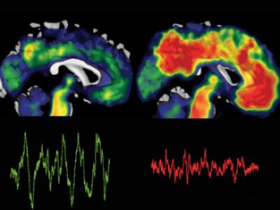 Brain scans showing a brain benefiting from deep sleep brain waves and an absence of beta-amyloid (left) and one that shows deposits of the toxic protein, beta-amyloid.