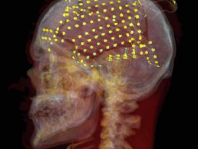 Skull x-ray with yellow dots indicating speech regions