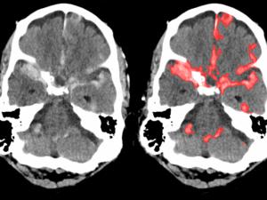 brain scan showing hemorrhage