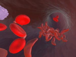 painting of sickled red blood cells