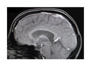 black and white image of a brain slice