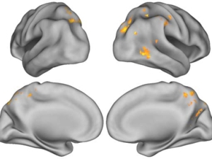 4 illustrations of partial brain scans