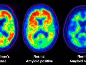 Scans of three different brains: one with alzheimers, one that is Amyloid positive, and one that is negative.