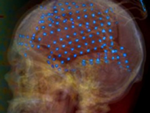 brain xray with dots