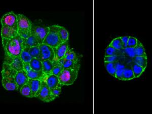Florescent images of malignant breast epithelial cells