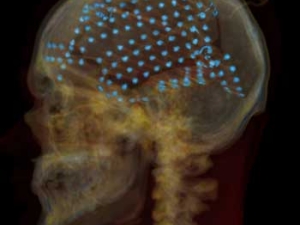 xray of brain with blue dots